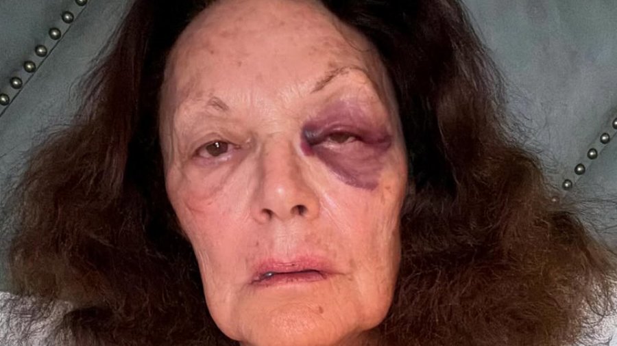 Η Diane von Furstenberg πόσταρε φωτό με το μαυρισμένο μάτι της και αποκάλυψε τι της συνέβη
